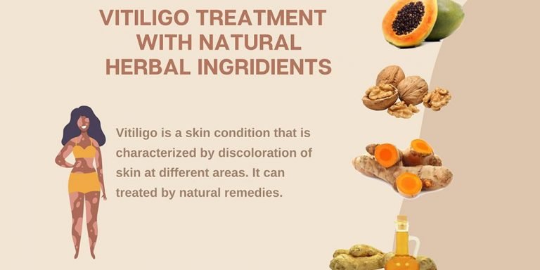 Vitiligo Natural Treatment and Remedies for Relief - Ujwala Ayurvedashram